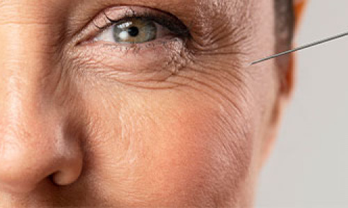 Information About Skin Wrinkles