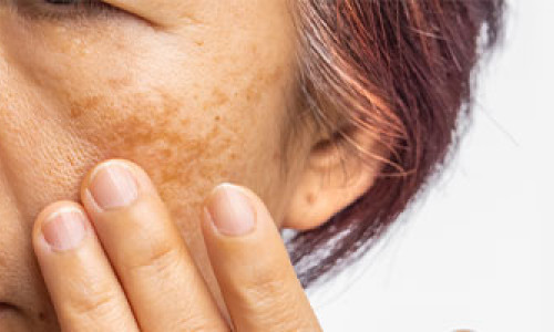 Information About Age Spots