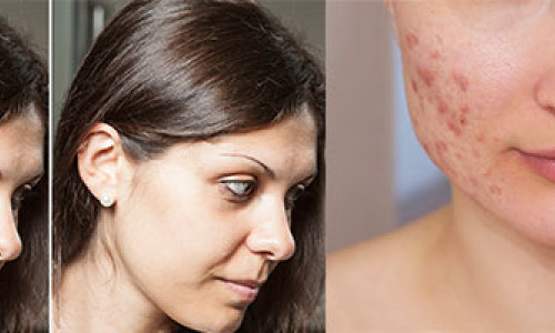 Information About Inflamed Acne