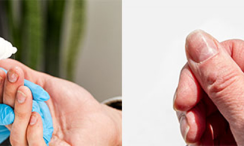 Important Information About Nail Fungus