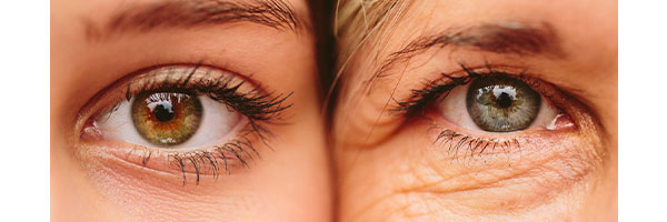 Information About Eye Wrinkles